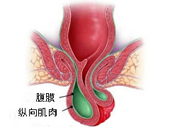 痔疮与直肠脱垂的区别